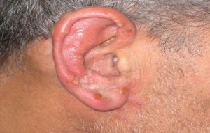 Illustration for article titled Obat Penyakit Herpes Tradisional